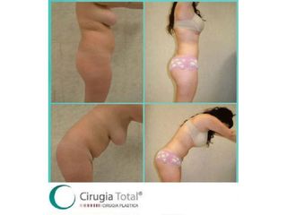 Antes y después de Liposucción 