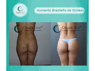 Antes y después de Gluteoplastia