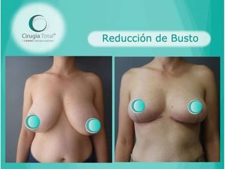 Antes y después de Reducción de mamas