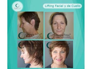Antes y después de Lifting 