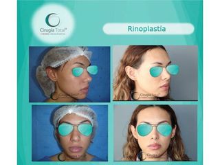 Antes y después de Rinoplastia