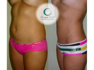 Antes y después de Abdominoplastia 