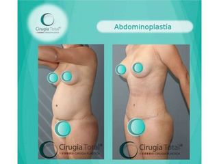 Antes y después de Abdominoplastia 