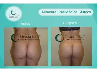 Antes y después de Gluteoplastia 