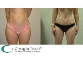 Antes y después de Liposucción 