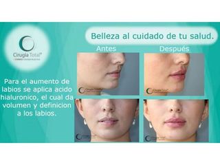 Antes y después de Aumento de labios 