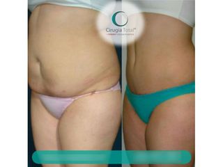 Antes y después de Abdominoplastia