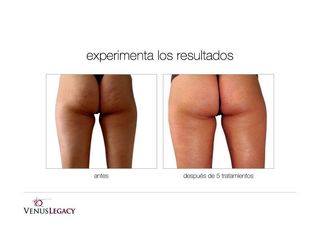 Antes y después de Tratamientos anticelulíticos