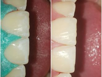 Implantes Dentales - 812649