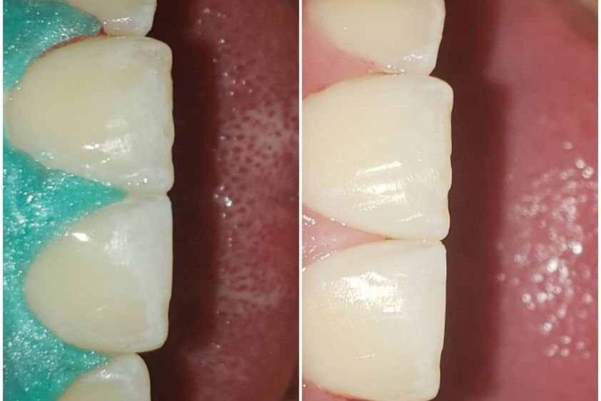Implantes Dentales antes y después - 812649