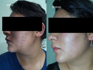 Antes y después de tratamiento Acné 
