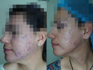Antes y después de Control de acné