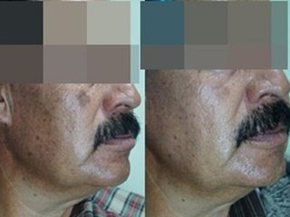 Antes y después de Hiperpigmentación y rejuvenecimiento facial
