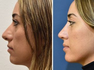 Antes y después de Rinoplastia  Phidias Facial & Aesthetics Center 