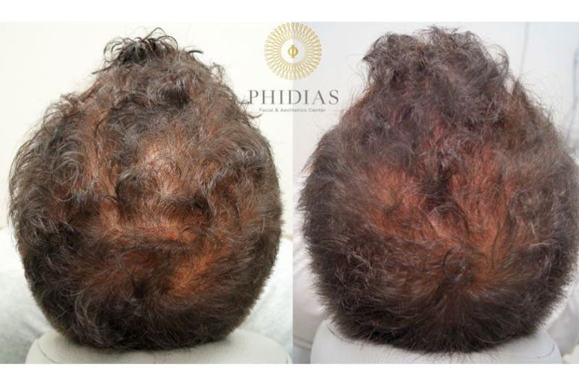 Plasma Rico en Plaquetas antes y después - 642475