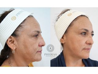 Antes y después de Rejuvenecimiento facial