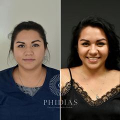 Antes y después de Bichectomía 