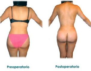 Lipoescultura