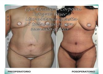 Lipo-Escultura Corporal Integral + Lipo-Abdominopastia Vaser + contorno caderas, glúteos - 5 tallas