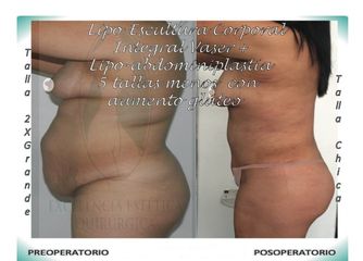Lipo-Escultura Corporal Integral + Lipo-Abdominopastia Vaser + Contorno caderas, glúteos - 5 tallas