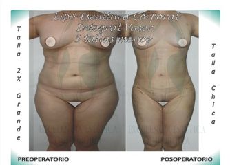 Lipo-Escultura Corporal Integral Vaser + Contorno de glúteos (injerto-graso) menos 5 tallas 