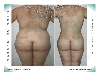 Lipo-Escultura Corporal Integral Vaser + Contorno de glúteos (injerto-graso) menos 5 tallas 