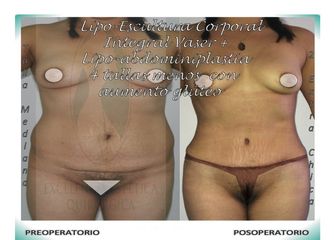 Lipo-Escultura Corporal Integral Vaser + Lipo-Abdominopastia Vaser menos 4 tallas + Aumento glúteo 