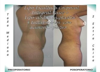 Lipo-Escultura Corporal Integral Vaser + Lipo-Abdominopastia Vaser menos 4 tallas + Aumento glúteo 