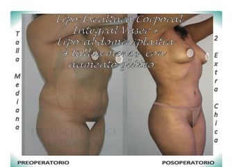 Lipo-Escultura Corporal Integral Vaser + Lipo-Abdominopastia Vaser menos 4 tallas + Aumento glúteo 1