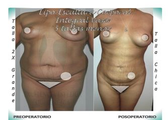 LIPO-ESCULTURA CORPORAL INTEGRAL VASER,  -5 TALLAS CON DISMINUCIÓN DE LAS ESTRÍAS Y DE GORDITOS