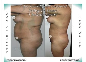 LIPO-ESCULTURA CORPORAL INTEGRAL VASER,  -5 TALLAS CON DISMINUCIÓN DE LAS ESTRÍAS Y DE GORDITOS