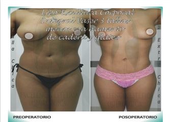LIPO-ESCULTURA CORPORAL INTEGRAL VASER menos 3 tallas + Aumento Cadera y Glúteo vista frontal