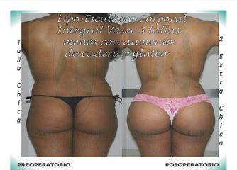 Lipo-Escultura Corporal Integral Vaser + Aumento de caderas y glúteos con Lipo-injerto graso