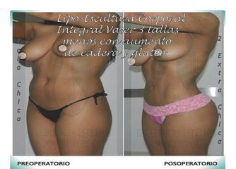 Lipo-Escultura Corporal Integral Vaser + Aumento de caderas y glúteos con Lipo-injerto graso