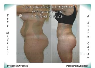 Lipo-Escultura Corporal Integral Vaser + contorno glúteo menos 4 tallas vista lateral