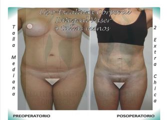 Lipo-Escultura Corporal Integral Vaser + Contorno de caderas y glúteos 4 tallas menos vista frontal 