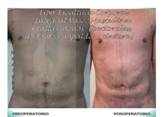 Lipo-Escultura integral corporal Vaser -4 tallas para hombres Vista fontal