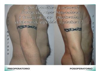 Lipo-Escultura integral corporal Vaser -4 tallas para hombres vista lateral