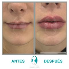 Aumento de labios vista anterior - Dr. Nephtali Alfonso Ortiz Lucio
