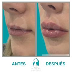 Aumento de labios viste lateral - Dr. Nephtali Alfonso Ortiz Lucio
