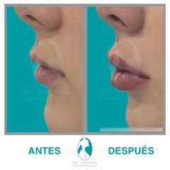 Aumento de labios vista lateral- Dr. Nephtali Alfonso Ortiz Lucio