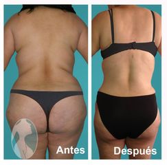 Lipo-Escultura Vaser y Lipo-Abdominoplastia Vaser vista posterior - Dr. Nephtali Alfonso Ortiz Lucio