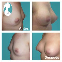 Aumento de busto - Dr. Nephtali Alfonso Ortiz Lucio
