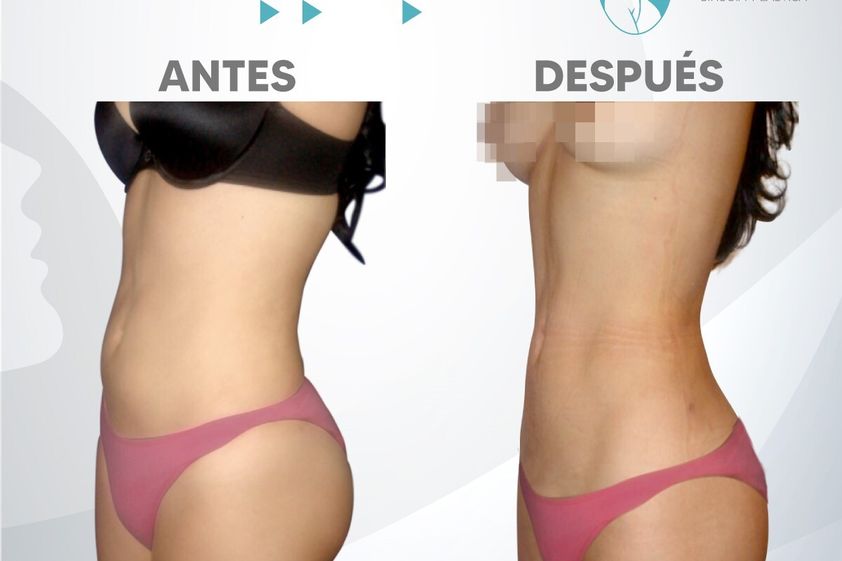 Liposucción antes y después - 859737