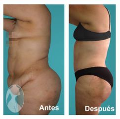 Lipo-Escultura Vaser y Lipo-Abdominoplastia Vaser vista lateral - Dr. Nephtali Alfonso Ortiz Lucio