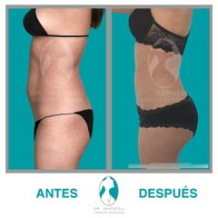 Lipo-Escultura VASER vista lateral- Dr. Nephtali Alfonso Ortiz Lucio