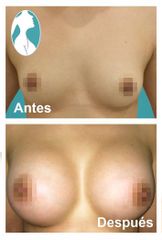 Aumento de busto - Dr. Nephtali Alfonso Ortiz Lucio