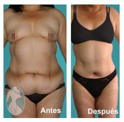 Lipo-Escultura VASER y Lipo-Abdominoplastia VASER vista anterior- Dr. Nephtali Alfonso Ortiz Lucio