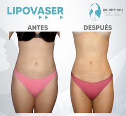 Liposucción - Dr. Nephtali Alfonso Ortiz Lucio
