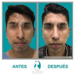Rinoplastia vista frontal - Dr. Nephtali Alfonso Ortiz Lucio